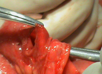 Vết thương thấu bụng