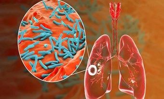 NGÀY BỆNH LAO THẾ GIỚI