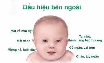 NGÀY HỘI CHỨNG DOWN THẾ GIỚI