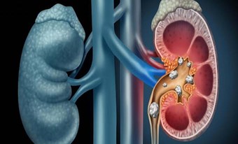 SONDE JJ NIỆU QUẢN BỊ “BỎ QUÊN” – CHUYỆN TƯỞNG NHỎ, HẬU QUẢ KHÔNG NHỎ