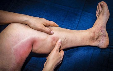 🚨 SƯNG ĐAU MỘT BÊN CHÂN – DẤU HIỆU CẢNH BÁO HUYẾT KHỐI TĨNH MẠCH SÂU, NGUY CƠ ĐE DỌA TÍNH MẠNG!