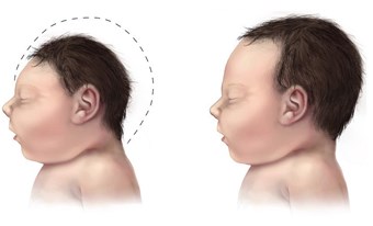 Dịch Zika xuất hiện ở thai phụ Việt Nam: Dấu hiệu bệnh và cách phòng tránh