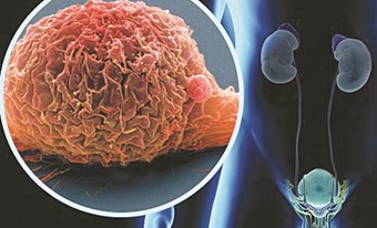 Nguy cơ gây ung thư bàng quang của thuốc Actos